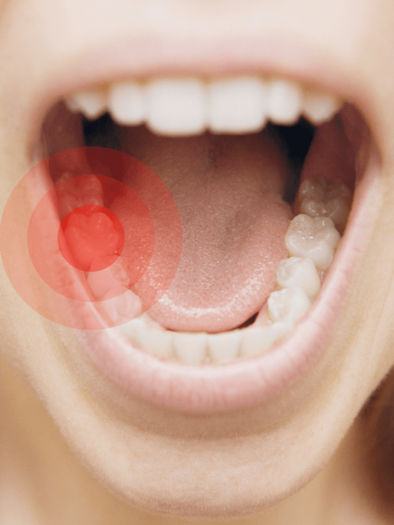Toothache